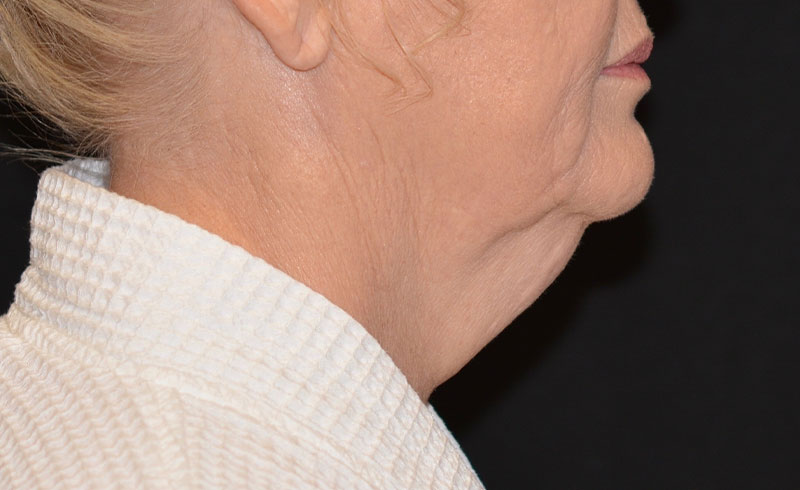 Coolsculpting Female Double Chin Before and After 05