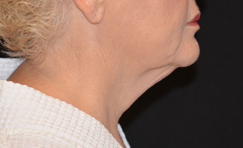 Coolsculpting Female Double Chin Before and After 07