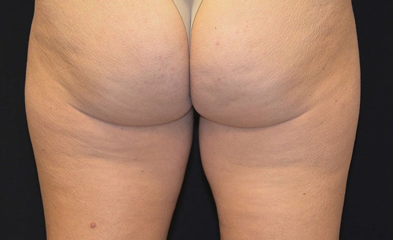 Coolsculpting Female Inner Thighs Before and After 01