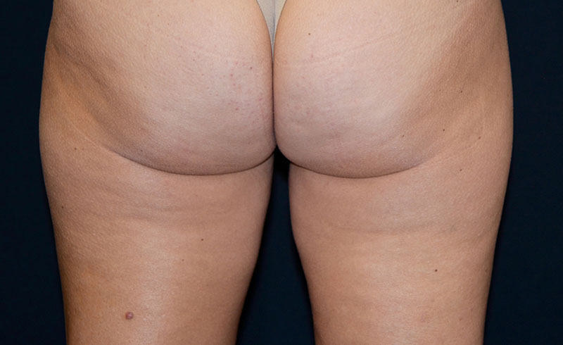 Coolsculpting Female Inner Thighs Before and After 01