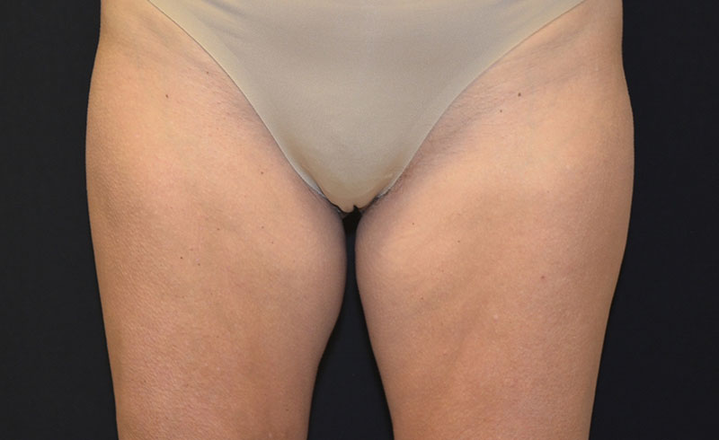 Coolsculpting Female Inner Thighs Before and After 03