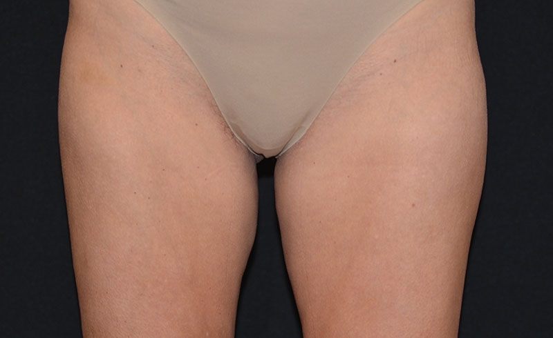 Coolsculpting Female Inner Thighs Before and After 06