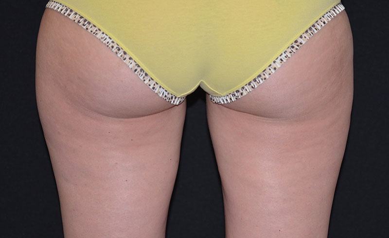 Coolsculpting Female Inner Thighs Before and After 08