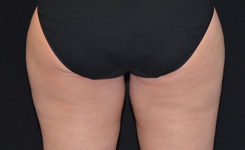 Coolsculpting Female Inner Thighs Before and After 05