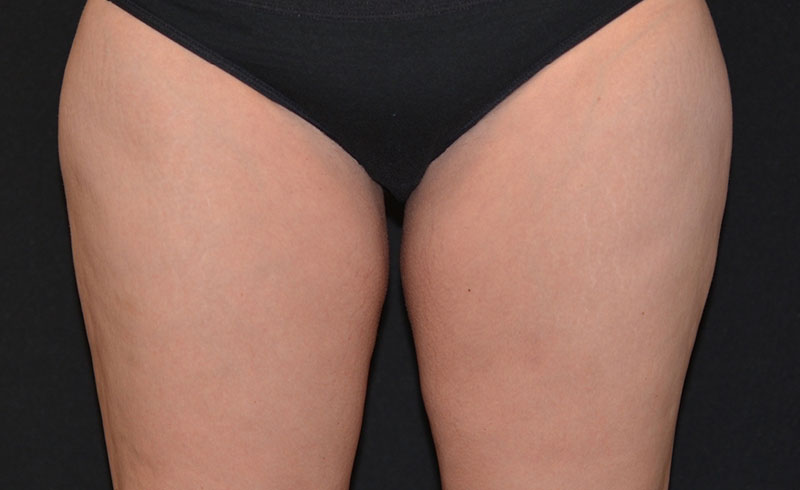 Coolsculpting Female Inner Thighs Before and After 02