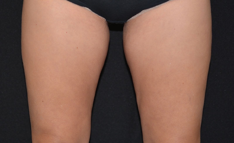 Coolsculpting Female Inner Thighs Before and After 08