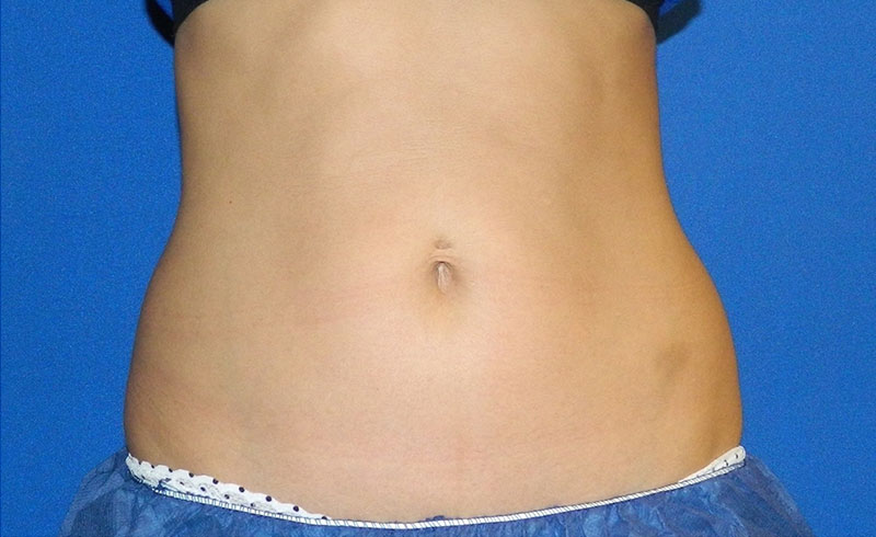 Coolsculpting Female Love Handles Before and After 01