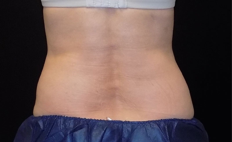 Coolsculpting Female Love Handles Before and After 12