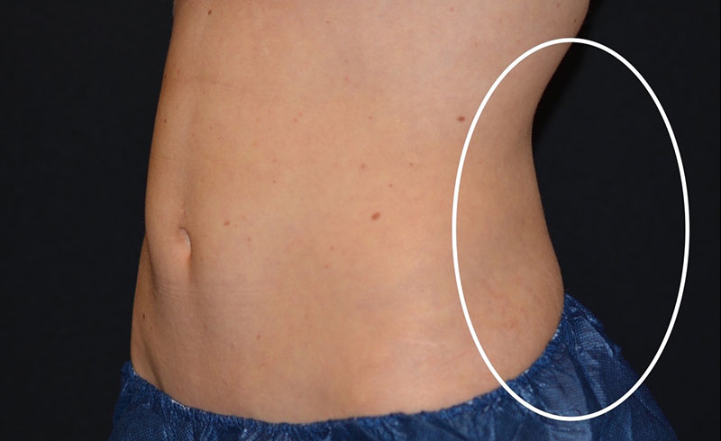 Coolsculpting Female Love Handles Before and After 04
