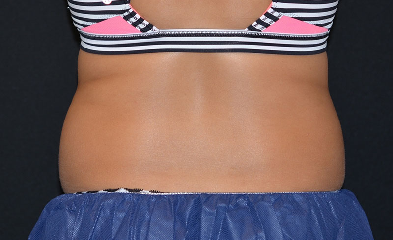 Coolsculpting Female Love Handles Before and After 06