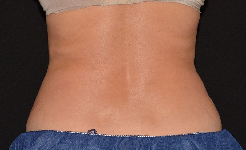 Coolsculpting Female Love Handles Before and After 11