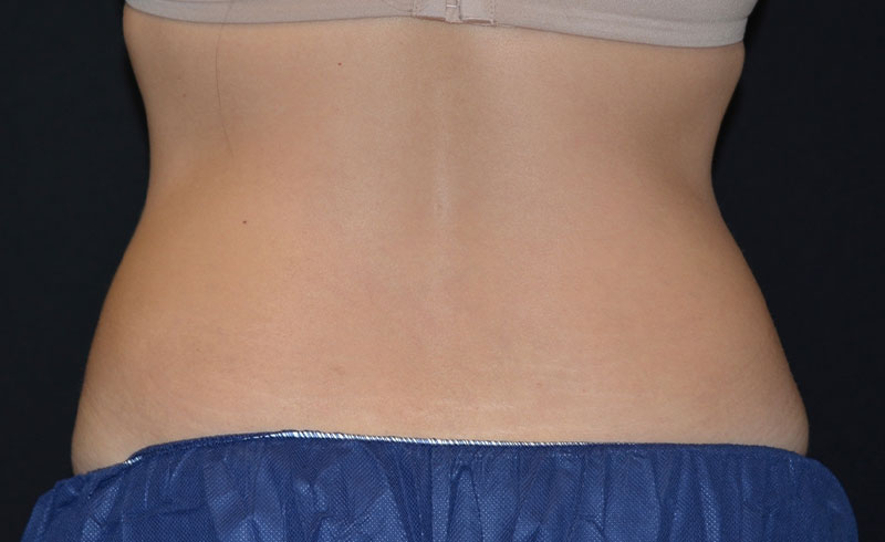 Coolsculpting Female Love Handles Before and After 10