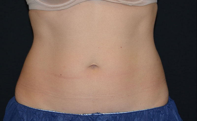 Coolsculpting Female Love Handles Before and After 03