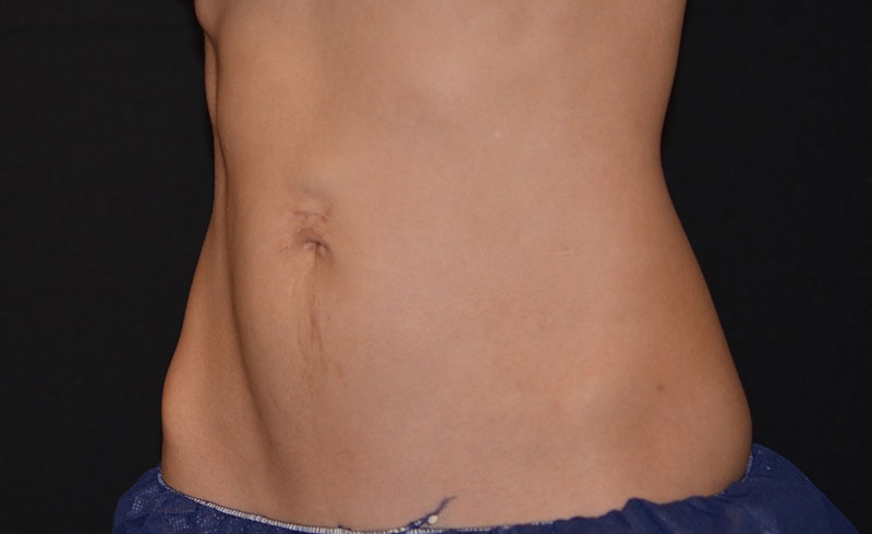 Coolsculpting Female Love Handles Before and After 10