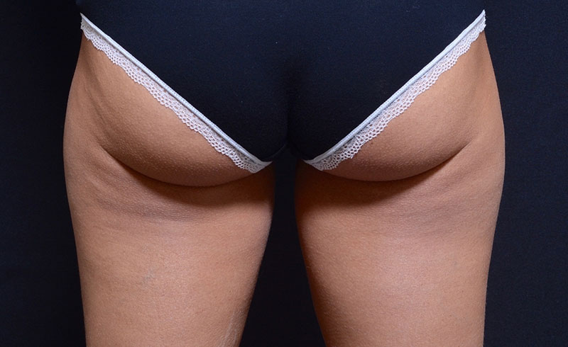 Coolsculpting Female Outer Thighs Before and After 03
