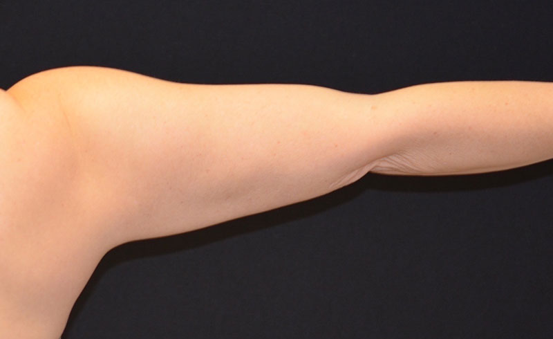 Coolsculpting Female Upper Arms Before and After 01