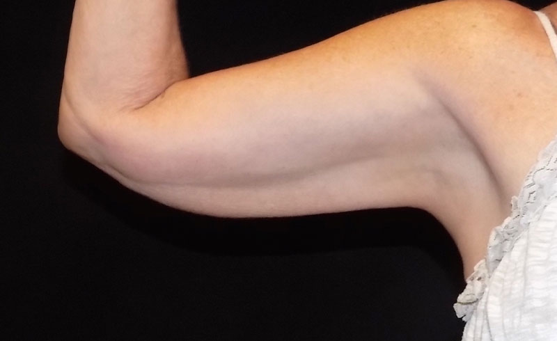 Coolsculpting Female Upper Arms Before and After 04