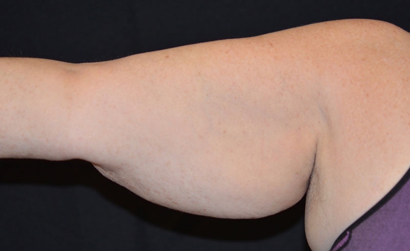 Coolsculpting Female Upper Arms Before and After 07