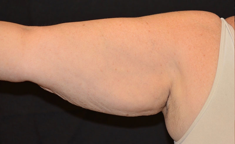 Coolsculpting Female Upper Arms Before and After 02