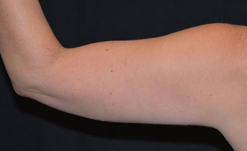 Coolsculpting Female Upper Arms Before and After 03