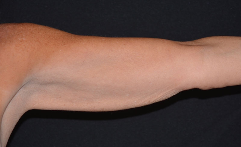 Coolsculpting Female Upper Arms Before and After 04