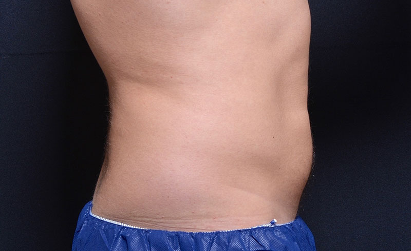 Coolsculpting Male Abs Before and After 10