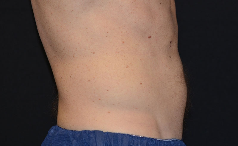 Coolsculpting Male Abs Before and After 04