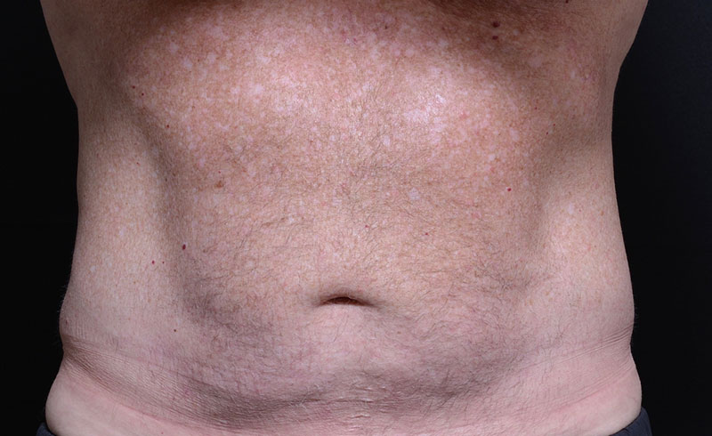 Coolsculpting Male Abs Before and After 09