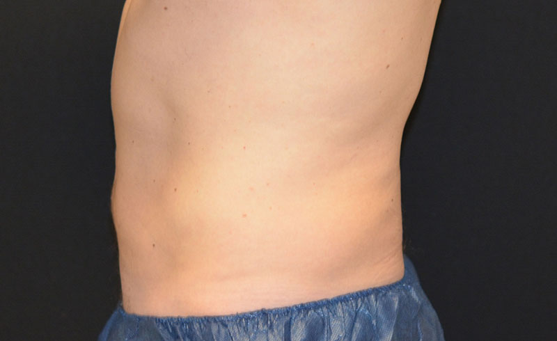 Coolsculpting Male Abs Before and After 05