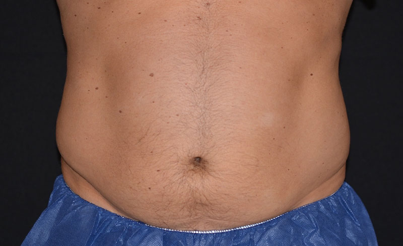 Coolsculpting Male Abs Before and After 02