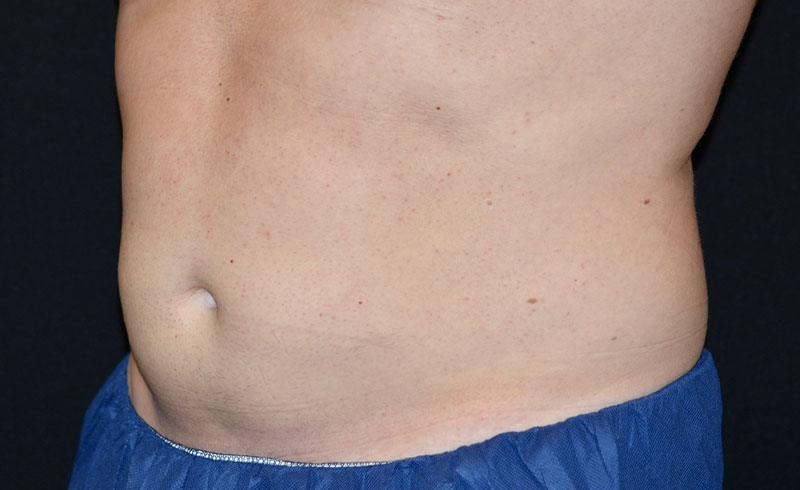 Coolsculpting Male Abs Before and After 11