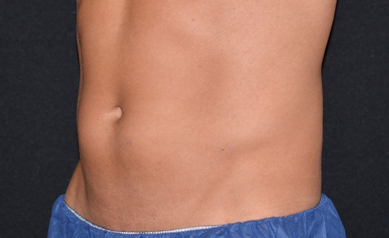Coolsculpting Male Abs Before and After 07