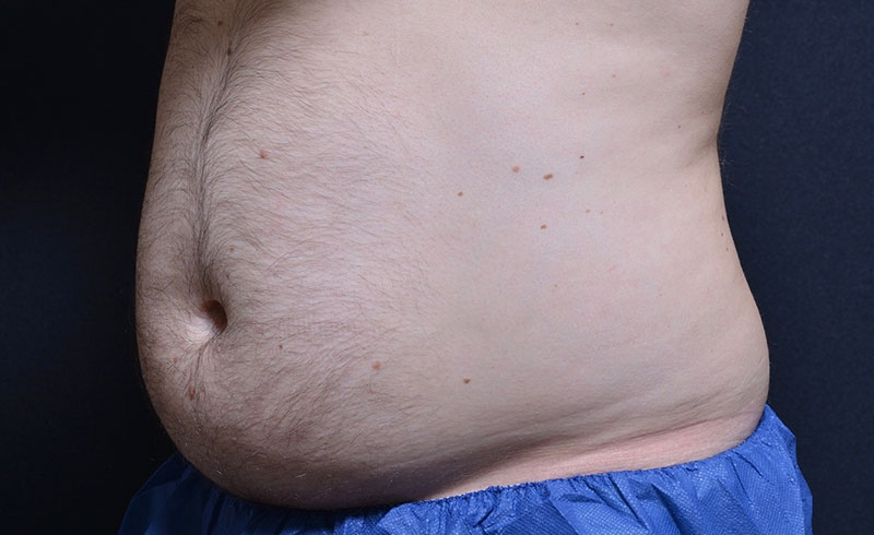 Coolsculpting Male Abs Before and After 11