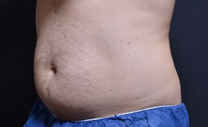 Coolsculpting Male Abs Before and After 03