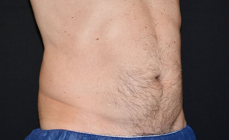 Coolsculpting Male Abs Before and After 06