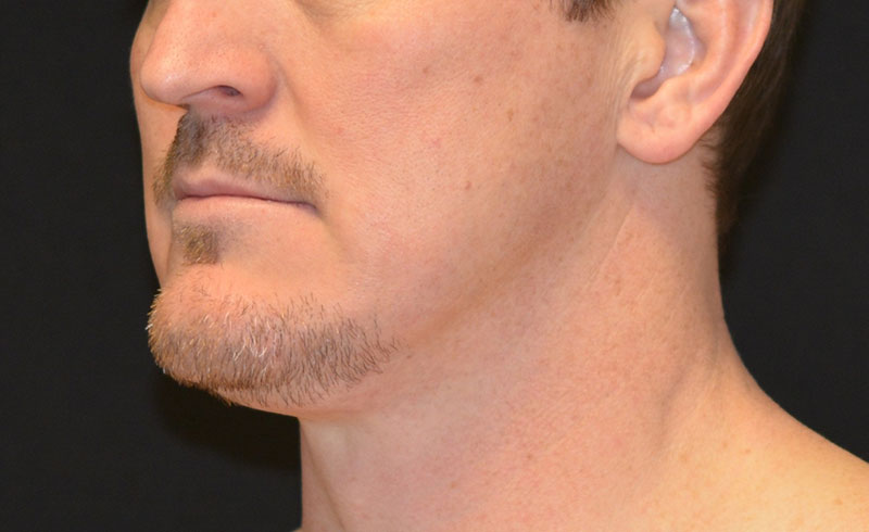 Coolsculpting Male Double Chin Before and After 04