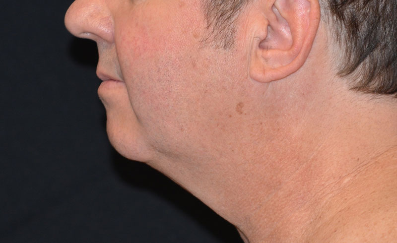 Coolsculpting Male Double Chin Before and After 03