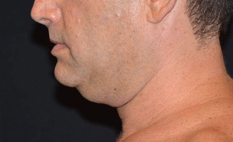 Coolsculpting Male Double Chin Before and After 05
