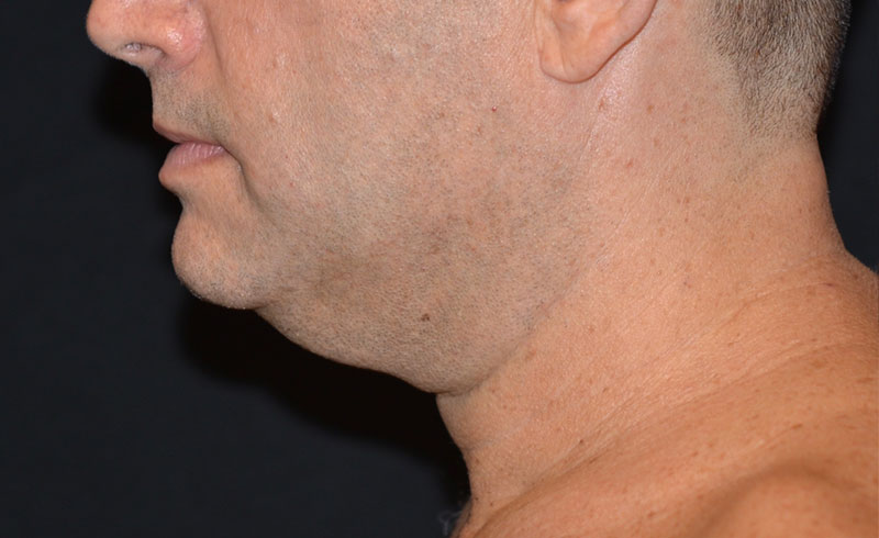 Coolsculpting Male Double Chin Before and After 01