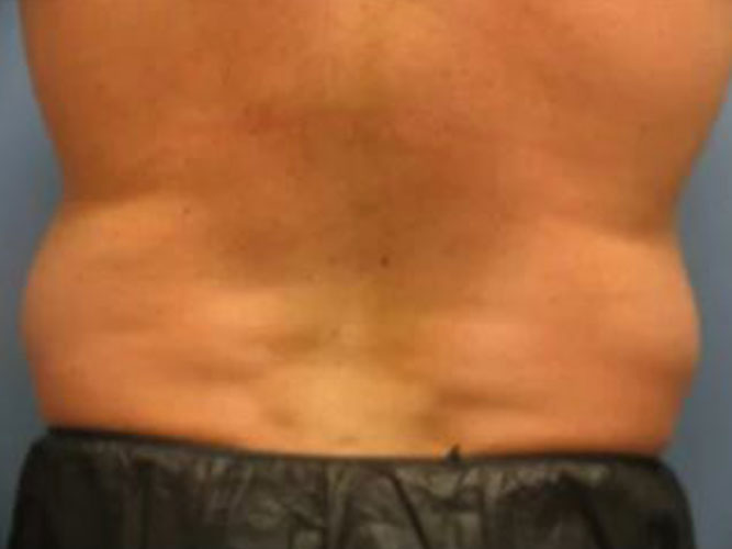 Coolsculpting Male Love Handles Before and After 01