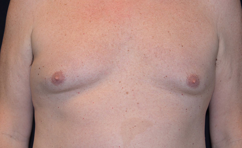 Coolsculpting Male Pecs Before and After 05