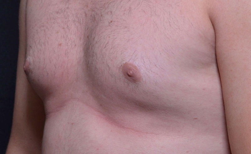 Coolsculpting Male Pecs Before and After 02