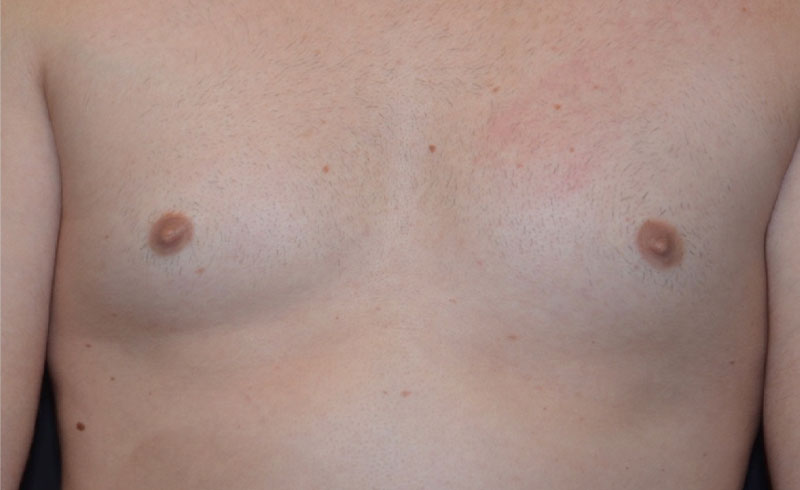 Coolsculpting Male Pecs Before and After 03