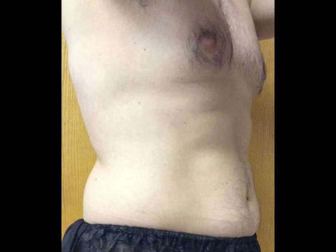 Coolsculpting Male Pecs Before and After 01