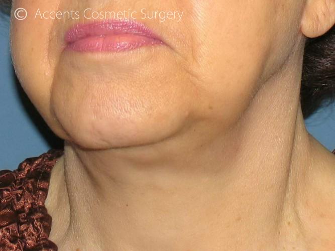 Exilis Face And Neck Before and After 01