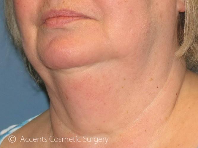 Exilis Face And Neck Before and After 02