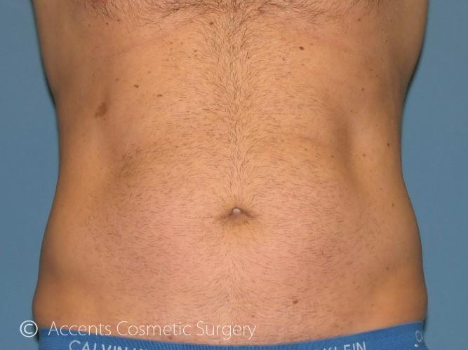 Exilis For Men Before and After 01