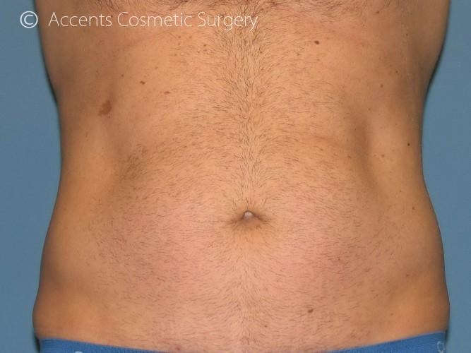 Exilis Before and After 01