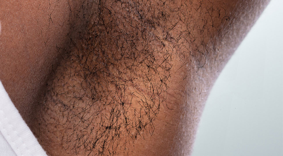Laser Hair Removal Before and After 01