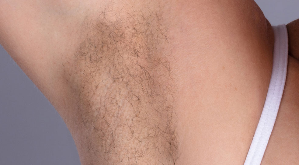 Laser Hair Removal Before and After 02